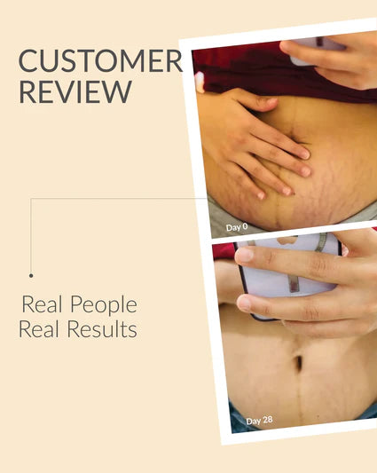 Anti-Stretch Marks Cream